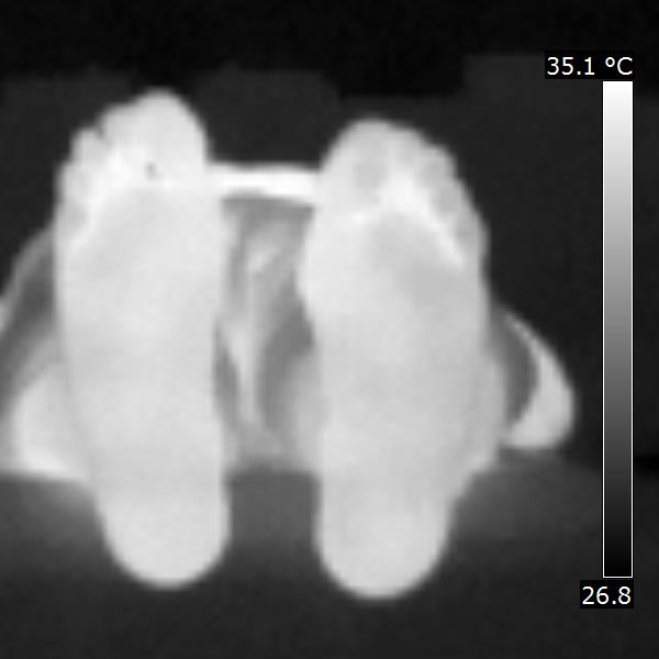 thermal foot analysis